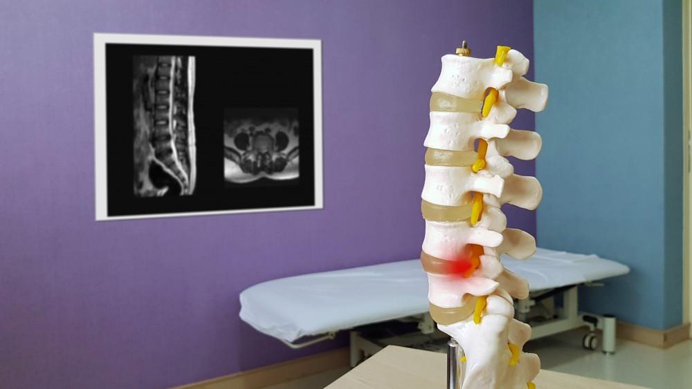 What Caused My Spinal Stenosis?