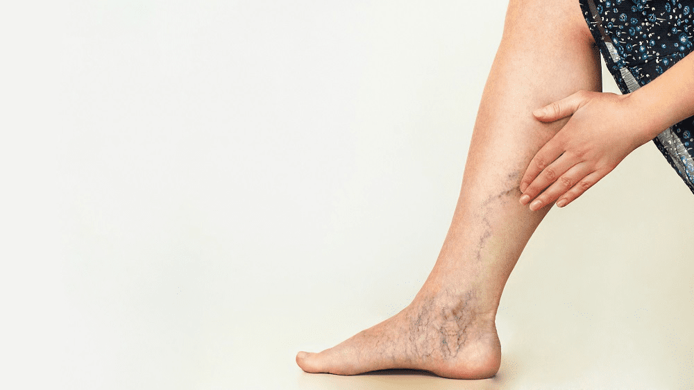 Consider these Benefits of Sclerotherapy